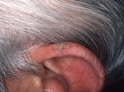 Hyperkeratoseläsion am linken Ohr